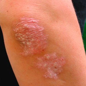 Psoriasis